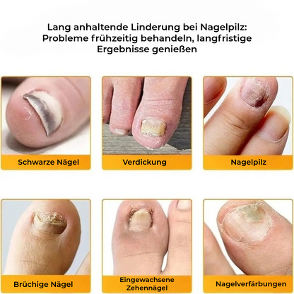 FungalPatch - Antibakterielles Antimykotisches Patch- und Nagelpflege-Set
