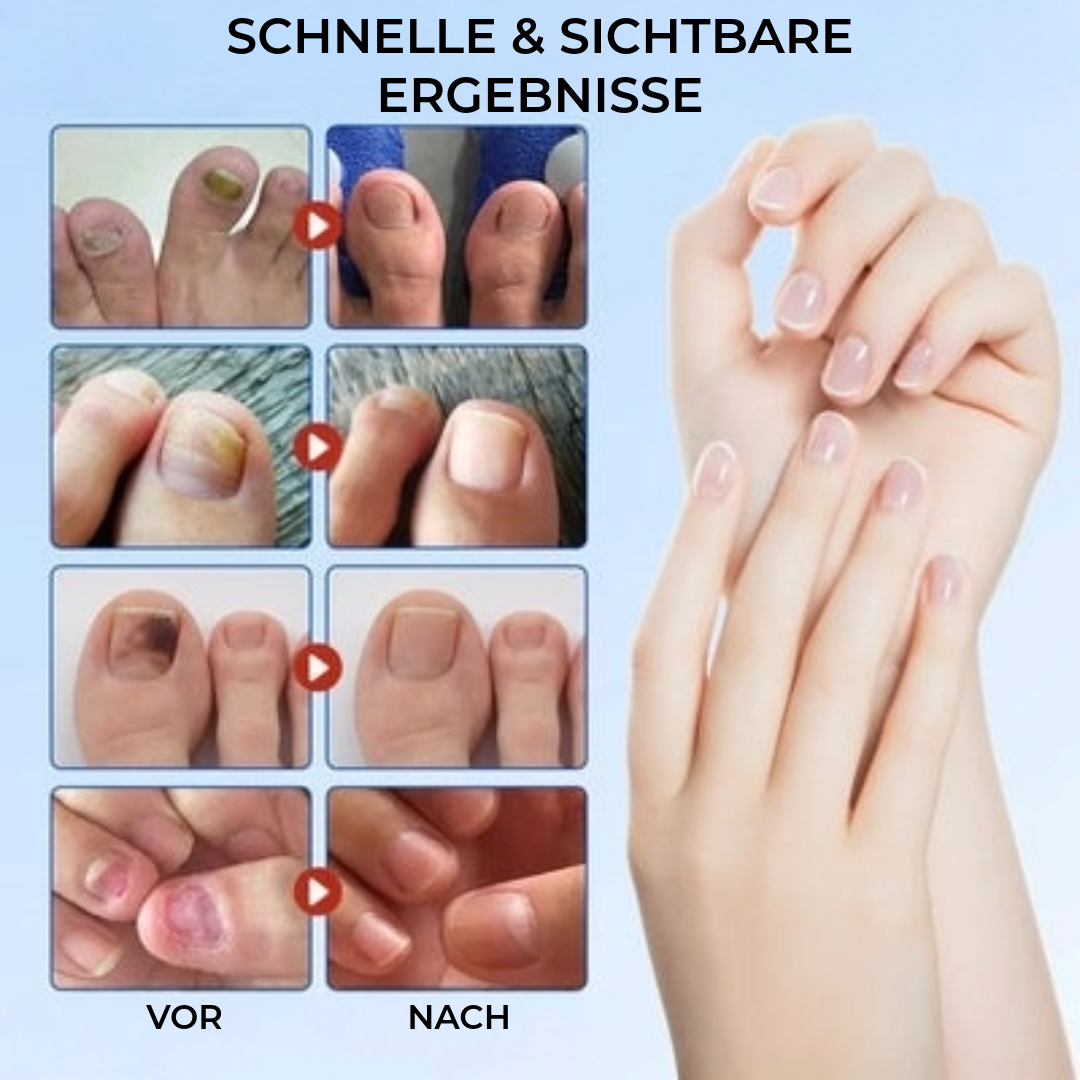 FungalPatch - Antibakterielles Antimykotisches Patch- und Nagelpflege-Set