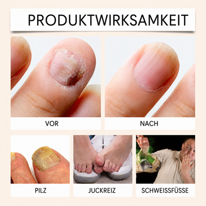 Bienengift-Spray gegen Nagelpilz